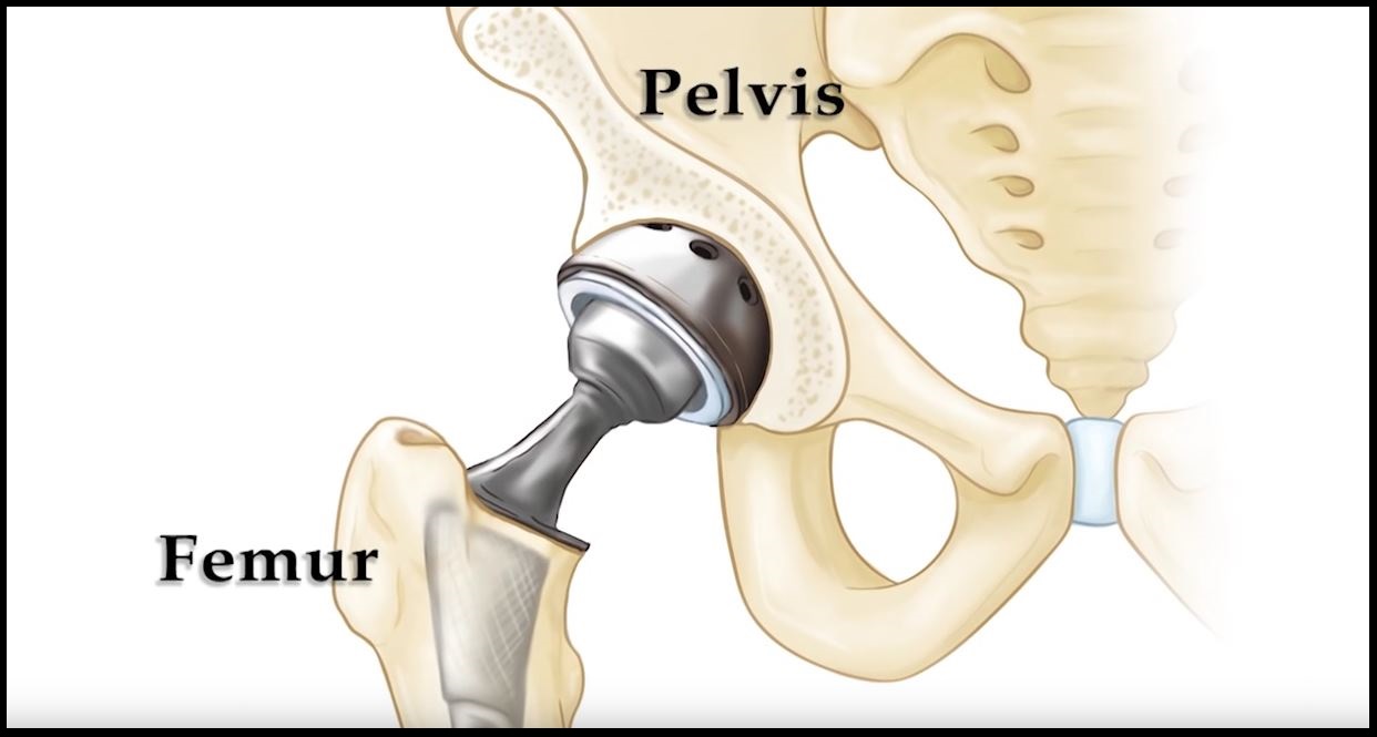 Hip replacement dr nilen shah joint replacement surgeon mumbai